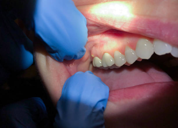 Best Emergency Dentist for Lost Fillings or Crowns in Seffner, FL